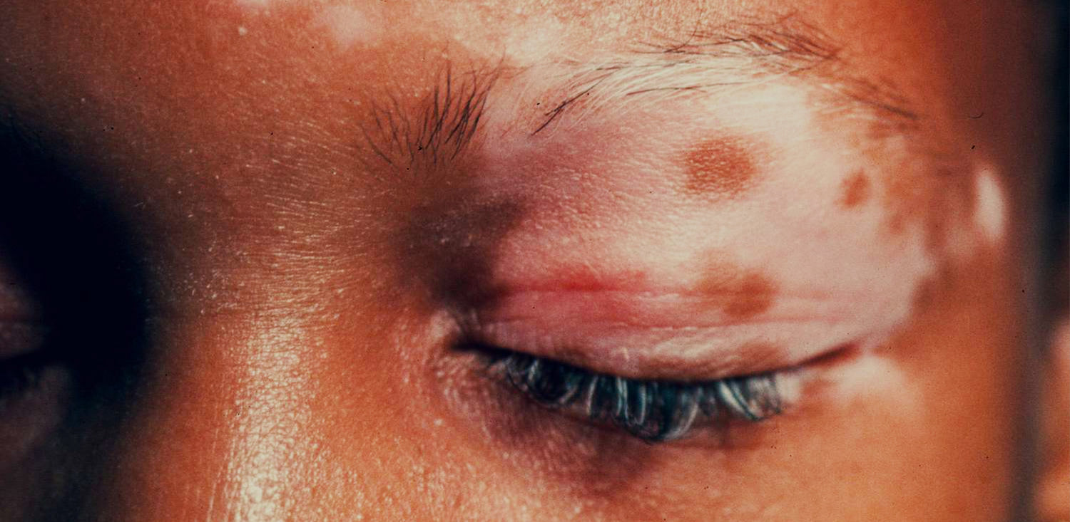 Types of pigmentation disorders and their treatments