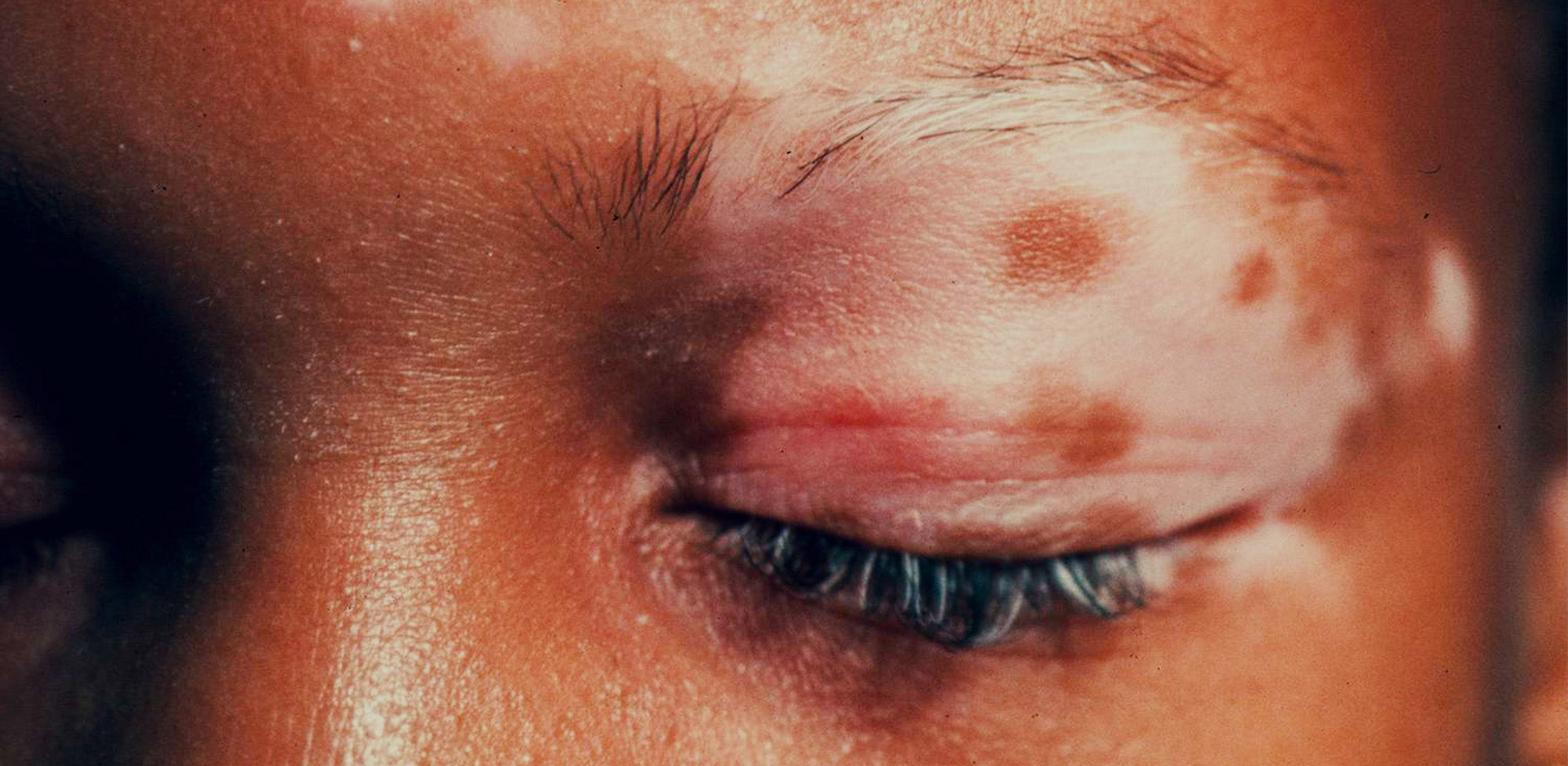 Types of pigmentation disorders and their treatments