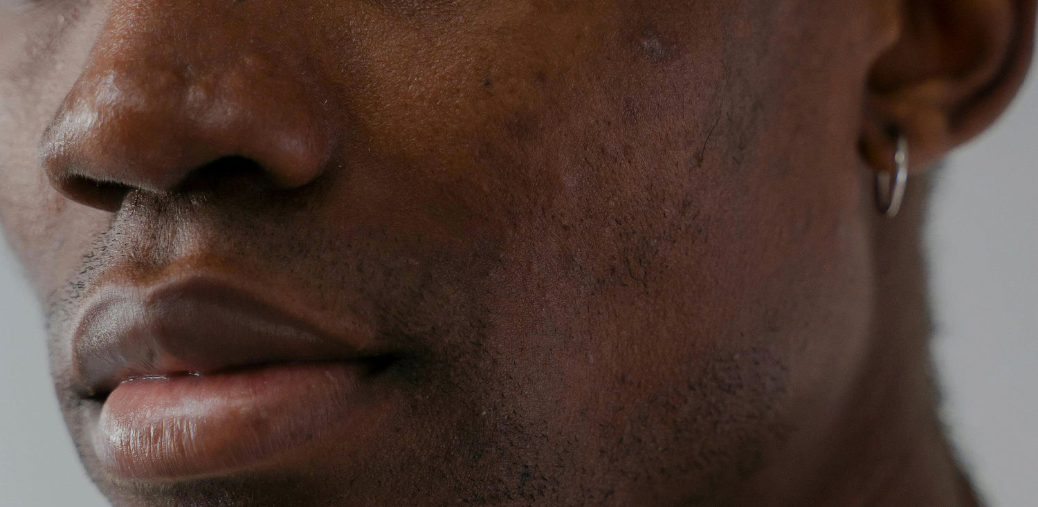 A simple guide to understanding hyperpigmentation